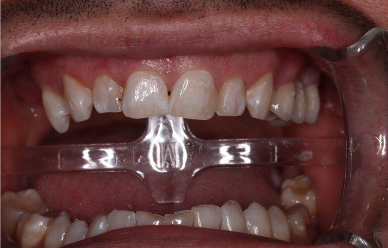 most pełnoceramiczny odtwarzający zęby od lewej górnej czwórki do szóstki z zaznaczonymi białymi odwapnieniami na powierzchniach koron, charakterystycznymi dla naturalnych zębów pacjenta po