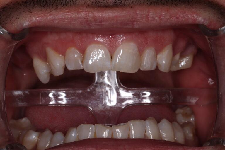 most pełnoceramiczny odtwarzający zęby od lewej górnej czwórki do szóstki z zaznaczonymi białymi odwapnieniami na powierzchniach koron, charakterystycznymi dla naturalnych zębów pacjenta przed